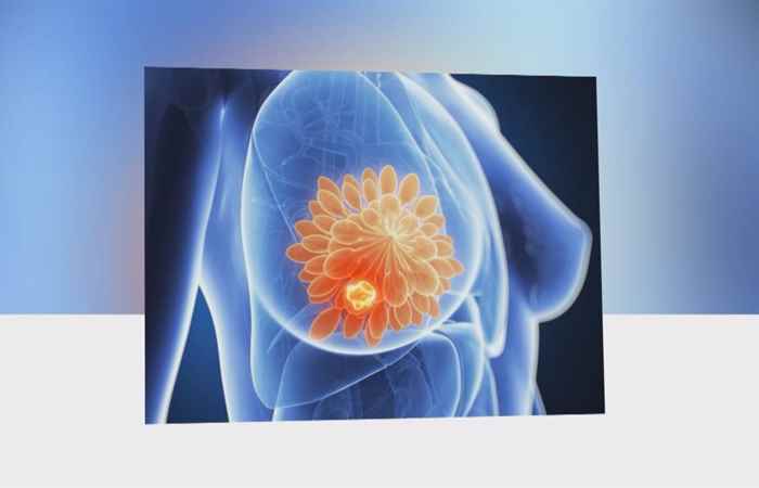 Sống khỏe 360 -  Xác định ung thư vú qua những dấu hiệu nào?  (13-03-2020)